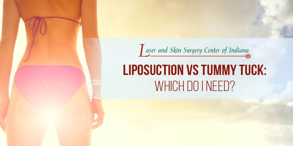 tumescent liposuction vs tummy tuck