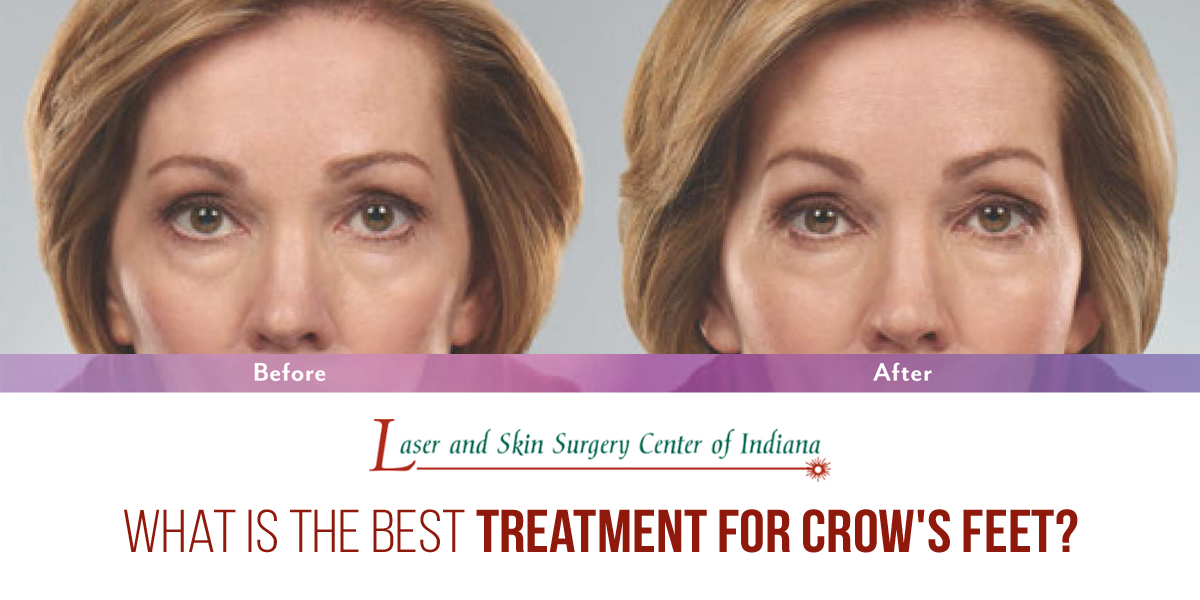 Crow S Feet Treatment Options Laser And Skin Surgery Center Of Indiana