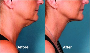 Kybella double chin reduction