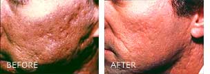 acne scars indianapolis