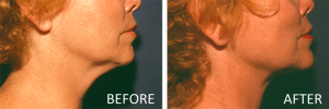 tumescent liposuction neck and face