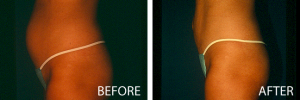 tumescent liposuction before and after belly fat