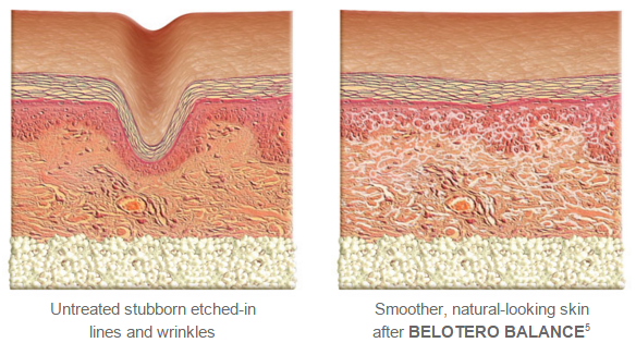 belotero wrinkle treatment