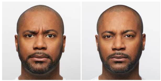 dysport before and after