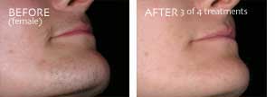 laser hair removal for the face