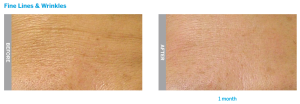 Indiana hydrafacial antiaging