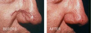 laser blood vessel removal of the nose