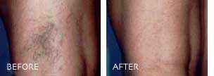 sclerotherapy for spider veins before and after pictures