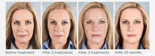 sculptra liquid facelift 