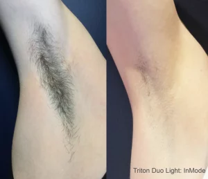 laser hair removal before and after