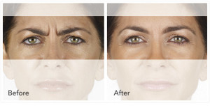 xeomin before and after