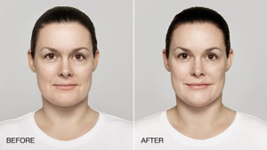 restylane lyft before and after