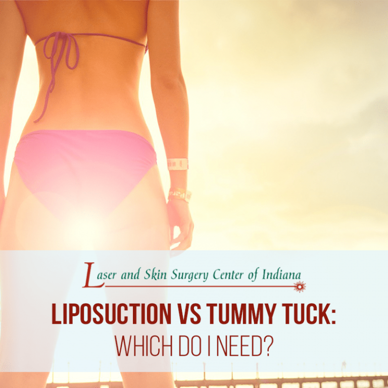 liposuction vs tummy tuck indianapolis