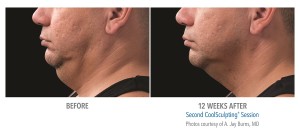 coolsculpting double chin before and after