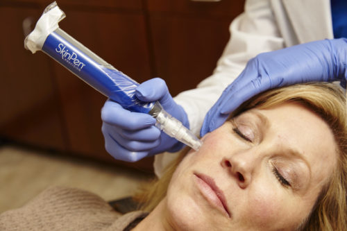 microneedling treatment indianapolis