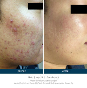 microneedling before and after skinpen