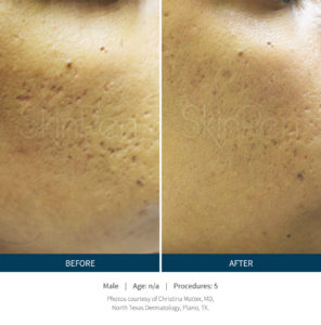 skinpen microneedling before and after photos for acne scars