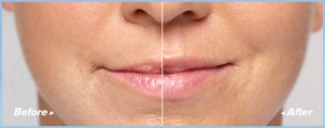 restylane silk for lip enhancement