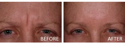 botox wrinkle relaxer