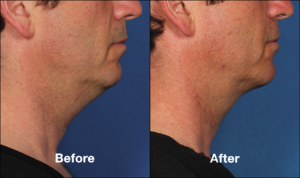 popular cosmetic treatments include double chin reduction