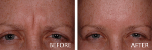 is Botox safe before and after