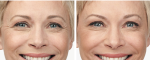 indianapolis botox for crows feet