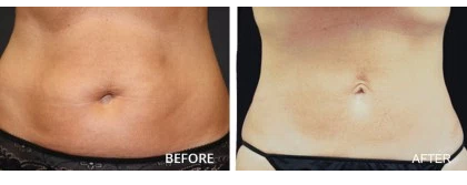 coolsculpting indianapolis