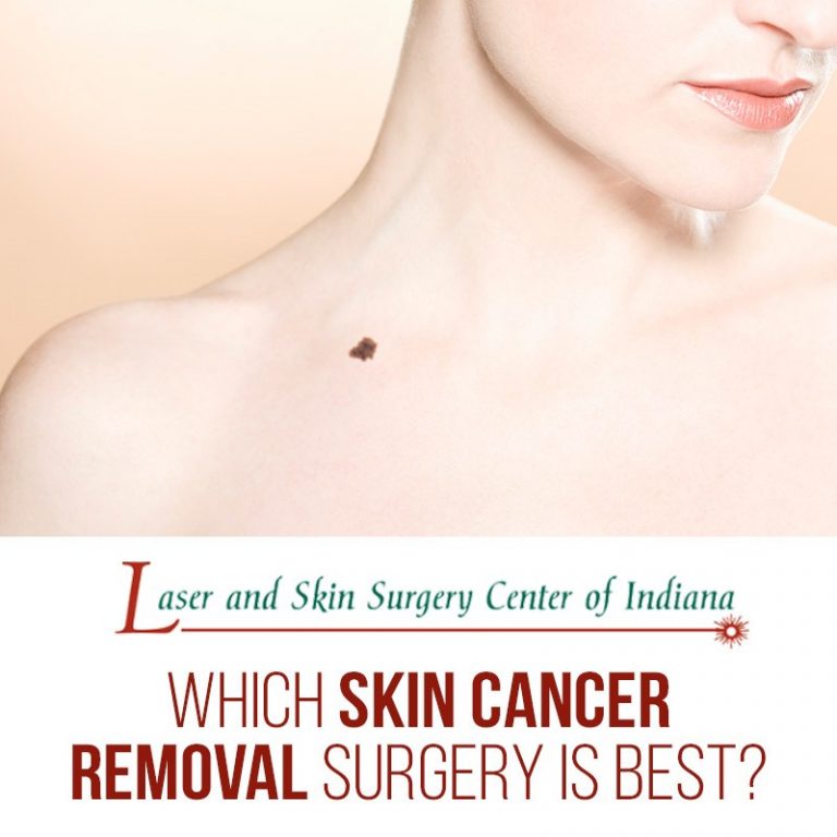 skin cancer removal surgery indianapolis