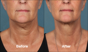 kybella jawline transformation and double chin reduction