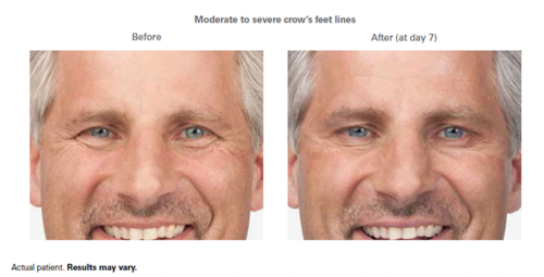 indianapolis botox before and after