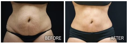 coolsculpting before and after