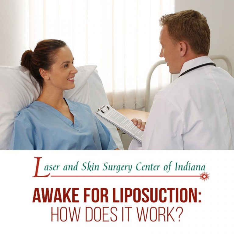 awake for liposuction tumescent liposuction safety indianapolis