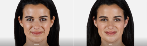 juvederm vollure indianapolis