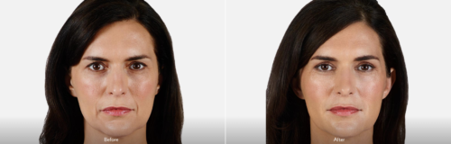 juvederm vollure carmel indiana
