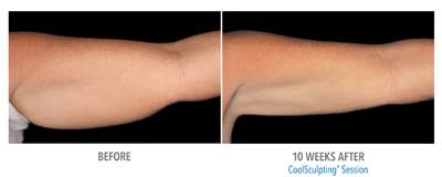 indiana coolsculpting for arms