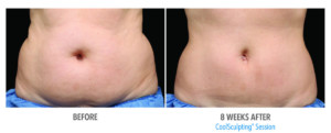 coolsculpting results