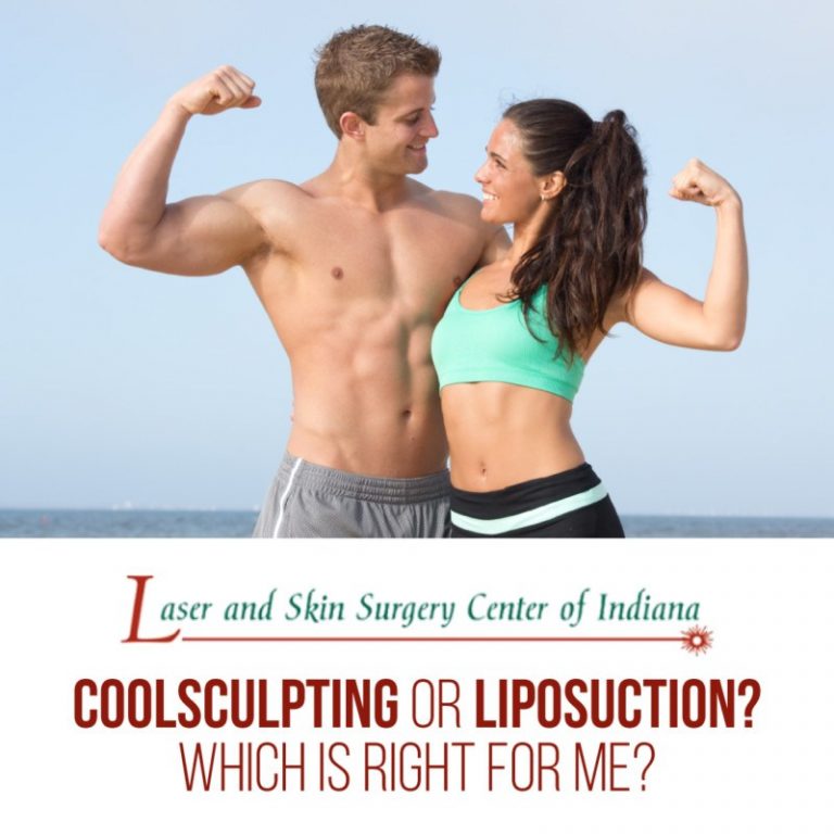 coolsculpting or liposuction indianapolis