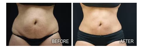 indianapolis coolsculpting before and after