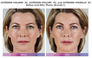 juvederm products before and after results