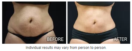 coolsculpting before and after photos