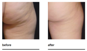 z-wave cellulite treatment before and after