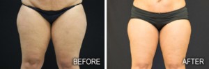 CoolSculpting Body Sculpting for Thighs