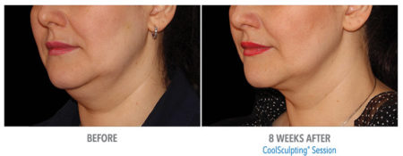 coolsculpting before and after