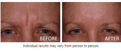 botox before and after photos