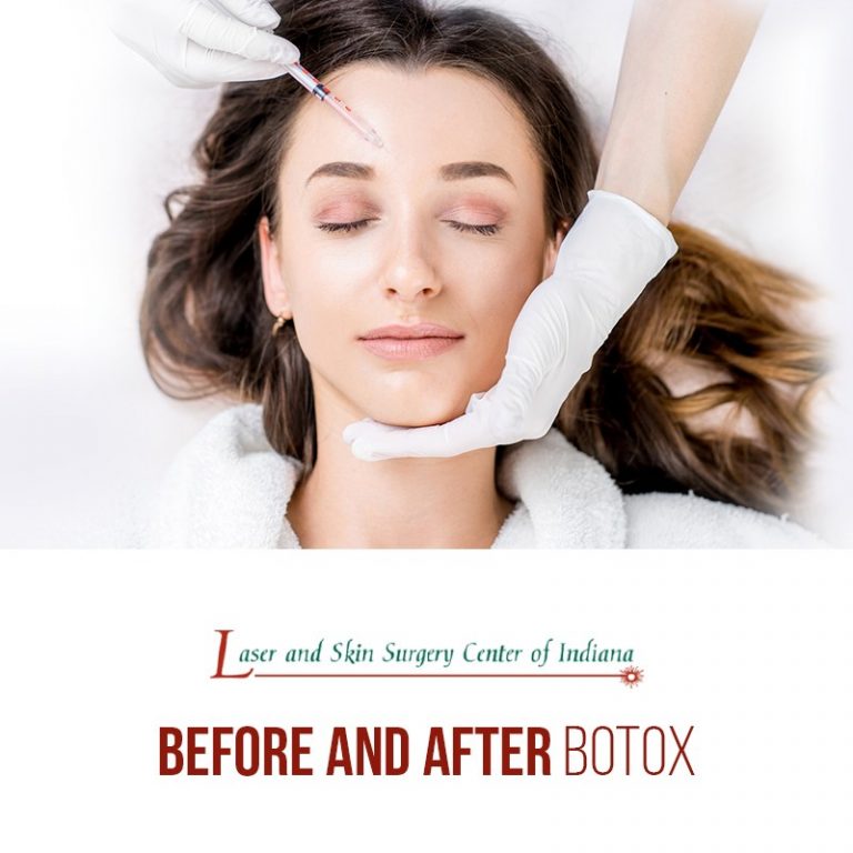 botox before and after photos indianapolis