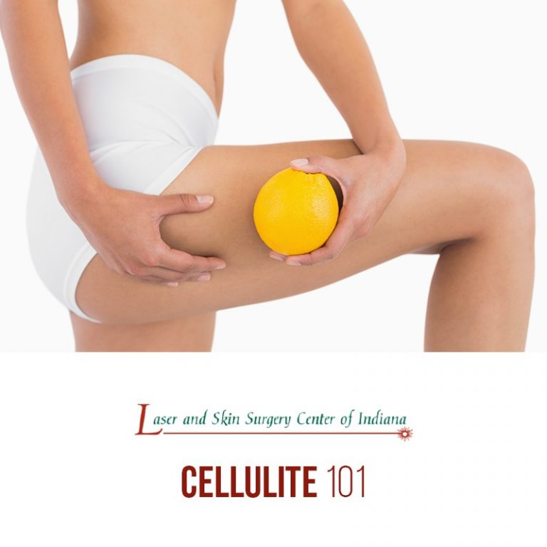 what is cellulite