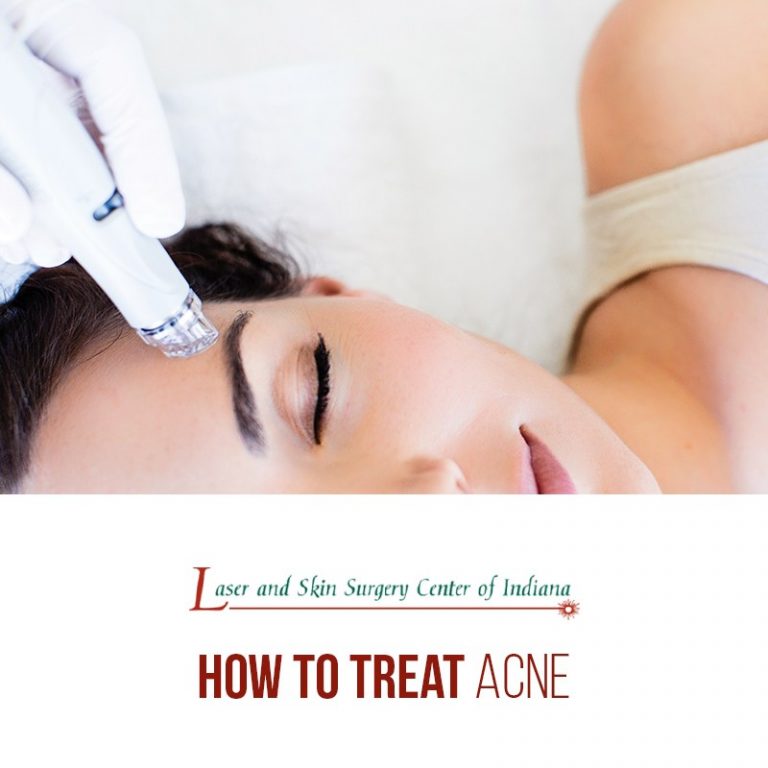 top 7 acne treatment options indianapolis