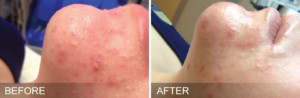 hydrafacial for acne before and after