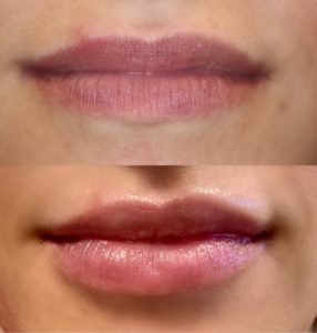 before and after lip injections in indianapolis