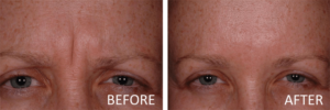 before and after botox indianapolis